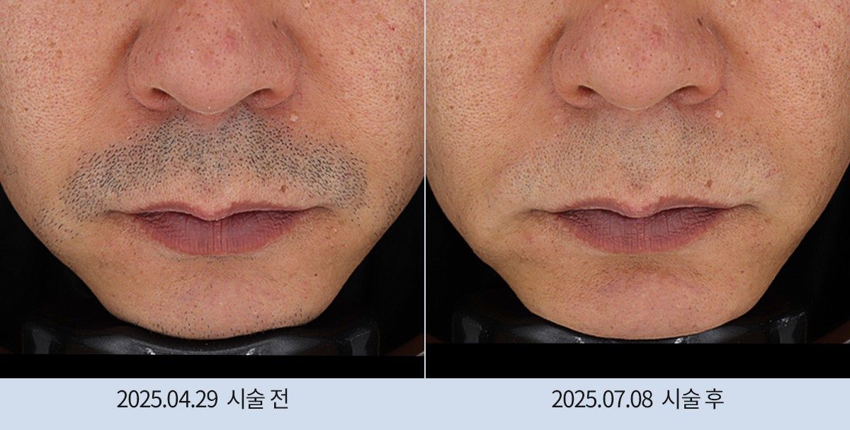 스노우의원 다산점 레이저 제모 전후