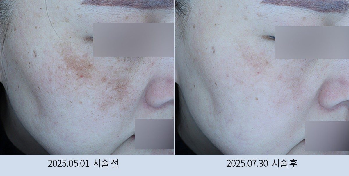 스노우의원 다산점 색소 시술 전후